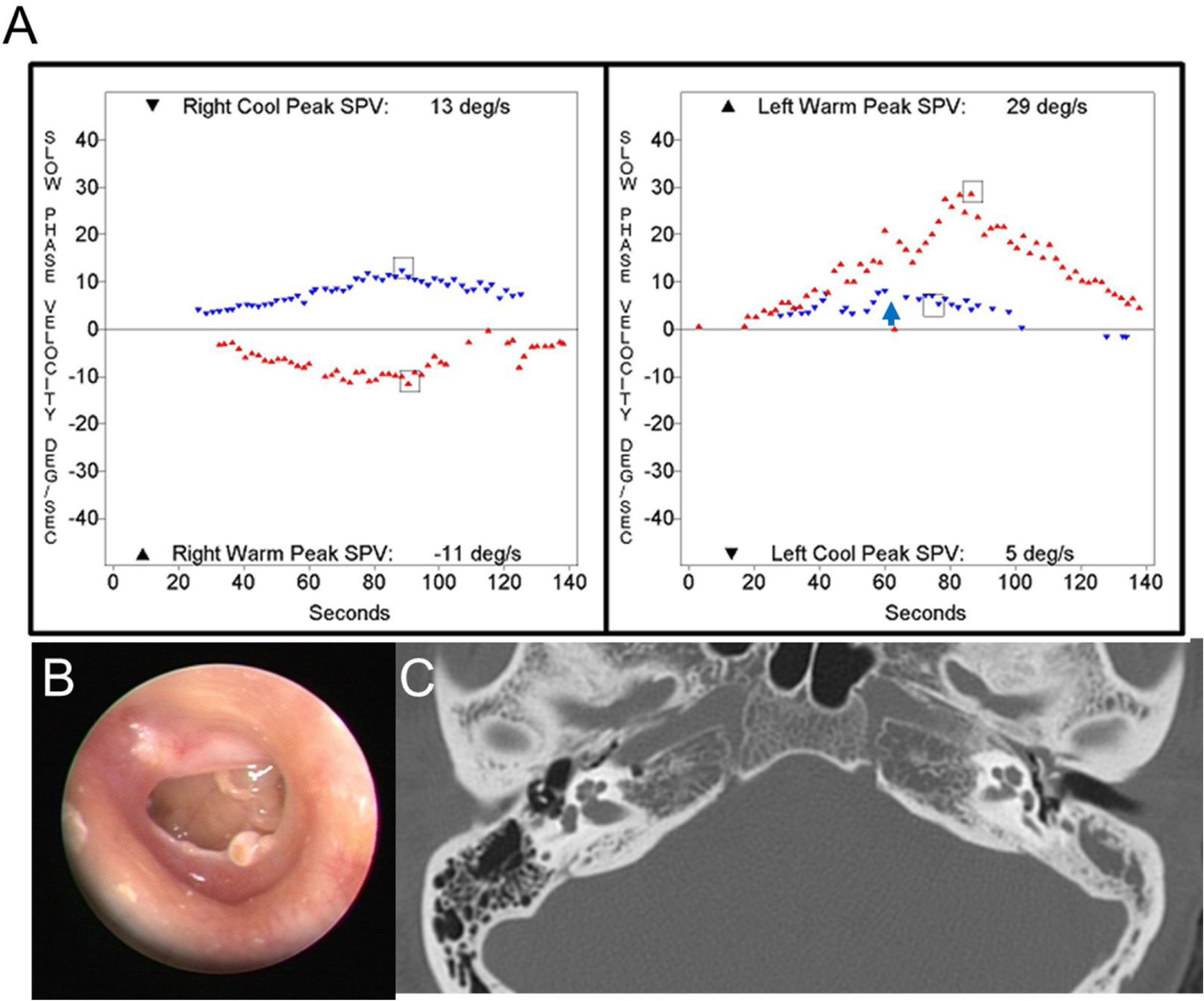 Clinical diagnoses of patients showing caloric inversion | Brazilian ...