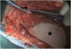 The submental flap was completed, and the distal facial vein of the facial artery was ready to be ligated. Black Arrow: facial artery and vein; Black pentagram: the finished submental flap.