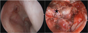 Nasal endoscopic observation of recurrent tumors and tumor resection in nasopharynx. Circle: tumor in the pharyngeal recess; Black pentagram: the boundary of tumor resection.