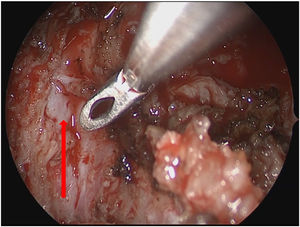 Nasal endoscopy revealed the internal carotid artery exposed at the lateral border of tumor resection. The red arrow: the internal carotid arteryindicates of the parapharyngeal.