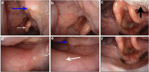 Endoscopic imaging of the location and invasion of tumour. Tumour labeled with blue arrow, the base of tongue with black arrow, epiglottis with white arrow.