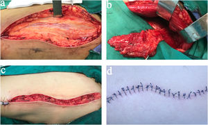 Surgical procedure of the flap preparation. (a) The thickness of excessive bulk of subcutaneous fat and skin fascial was more than 2cm; (b) Flap raising was finished; (c and d) the photos of donor site.