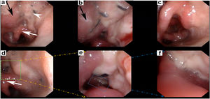 Pharyngorhinoscopy imaging of patient on tenth day after the surgery. (a) The black arrow showed the tongue base; the white arrowhead showed the restoration of soft tissue with myofascial flap; the white arrow showed the epiglottis; (b) The commissure between tongue base (black arrow) and myofascial flap was well; (c) The mobility of epiglottis was well when the patient pronounced the sound of “ei” ; (d, e and f) The commissure between myofascial ALT flap and epiglottis was reconstructed well with smooth and soft texture of surface.