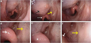 Patient at the six-month follow-up. Flap labelled with yellow arrow, the base of tongue with black arrow, epiglottis with white arrow.