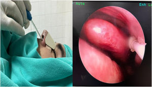 Sphenopalatine ganglion block application with the sphenocath device under general anesthesia.