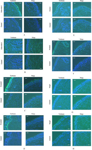 Photomicrographs of fluorescence immunohistochemical staining of the turbinate and nasal polyp for the PCP proteins. Green and blue colors express the fluorescence of Alexa Fluor 488 and DAPI, respectively. Scale bar = 20 μm. (A) Dishevelled-1. Moderate fluorescence is observed on the surface of the turbinate mucosa, whereas the nasal polyp shows no immunoreactivity. (B) Dishevelled-3. Weak fluorescence is observed on the surface of the turbinate mucosa, whereas the nasal polyp shows no immunoreactivity. (C) Frizzled3. Strong and weak fluorescence are seen on the surface of the turbinate mucosa and nasal polyp, respectively. (D) Frizzled6. Weak and moderate fluorescence are observed on the surface and in the basal layer of the turbinate epithelium, respectively, while the nasal polyp shows no immunoreactivity. (E) Prickle1. There is no immunoreactivity in either the turbinate mucosa or nasal polyp. (F) Prickle2. Moderate and weak fluorescence are seen on the surface of the turbinate mucosa and nasal polyp, respectively. (G) Vangl1. There is no immunoreactivity in either the turbinate mucosa or nasal polyp. (H) Vangl2. Weak fluorescence is observed on the surface of the turbinate mucosa, whereas the nasal polyp shows no immunoreactivity.