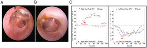 A 77-year-old patient with bilateral chronic otitis media. Otoendoscopic examination showed tympanic membrane perforation on the right (A) and left side (B). (C) A caloric inversion by warm air irrigation was observed on both sides (red arrows).