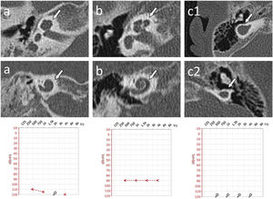 Cochlear malformations identified in computed tomography evaluation and presented in the planes selected for the most precise visualization. Each panel represents a particular patient: (a) Case #2 right ear, cochlear hypoplasia type II; (b) Case #1 right ear, cochlear hypoplasia type III; (c) Case #10 right ear, (c1) Cochlear Aplasia with a Dilated Vestibule (CADV); (c2) Rudimentary otocyst. White arrows indicate anomaly location. Individual cases are supplemented with ASSR reconstruction of audiograms (hearing thresholds in dBnHL), respectively.