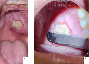Ulceration at initial assessment (10th day of onset of symptoms). (A) Ulceration on the hard palate posteriorly, on the left, and near the midline, with central necrotic tissue and perilesional edema without erythema or bone exposure. (B) Dimensions 2.0 × 2.5 cm.