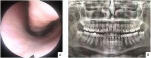 Complementary exams. (A) Flexible nasolaryngoscopy shows the inferior meatus of the left nostril. No signs of fistula on the nasal floor. (B) Panoramic radiograph of the face without bone erosion.