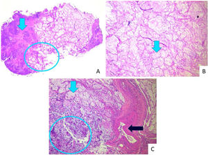 Histopathology. Extensive infarction of mucous salivary glands and adjacent tissues with several thrombosed vessels in different stages of organization. (A) Arrow indicates coagulative necrosis; circle: interface with acinar necrosis. (B) Arrow shows necrosis with preserved acinar architecture. (C) Blue light arrow: acinar necrosis; circle: islands of squamous metaplasia; black arrow: vascular thrombosis.