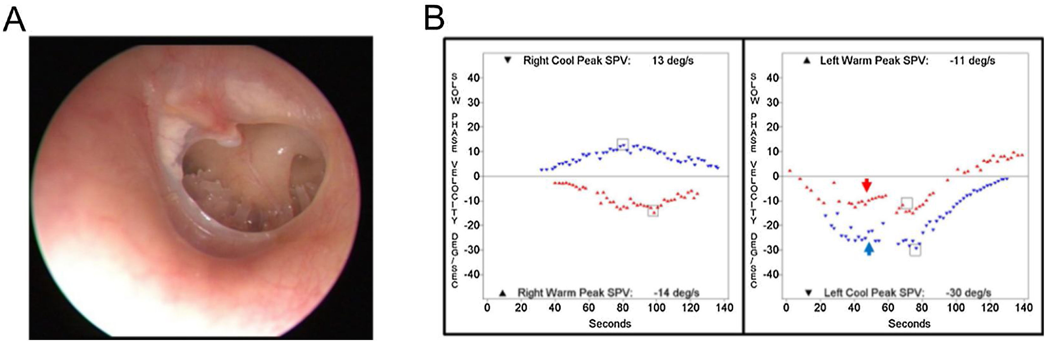 Clinical diagnoses of patients showing caloric inversion | Brazilian ...