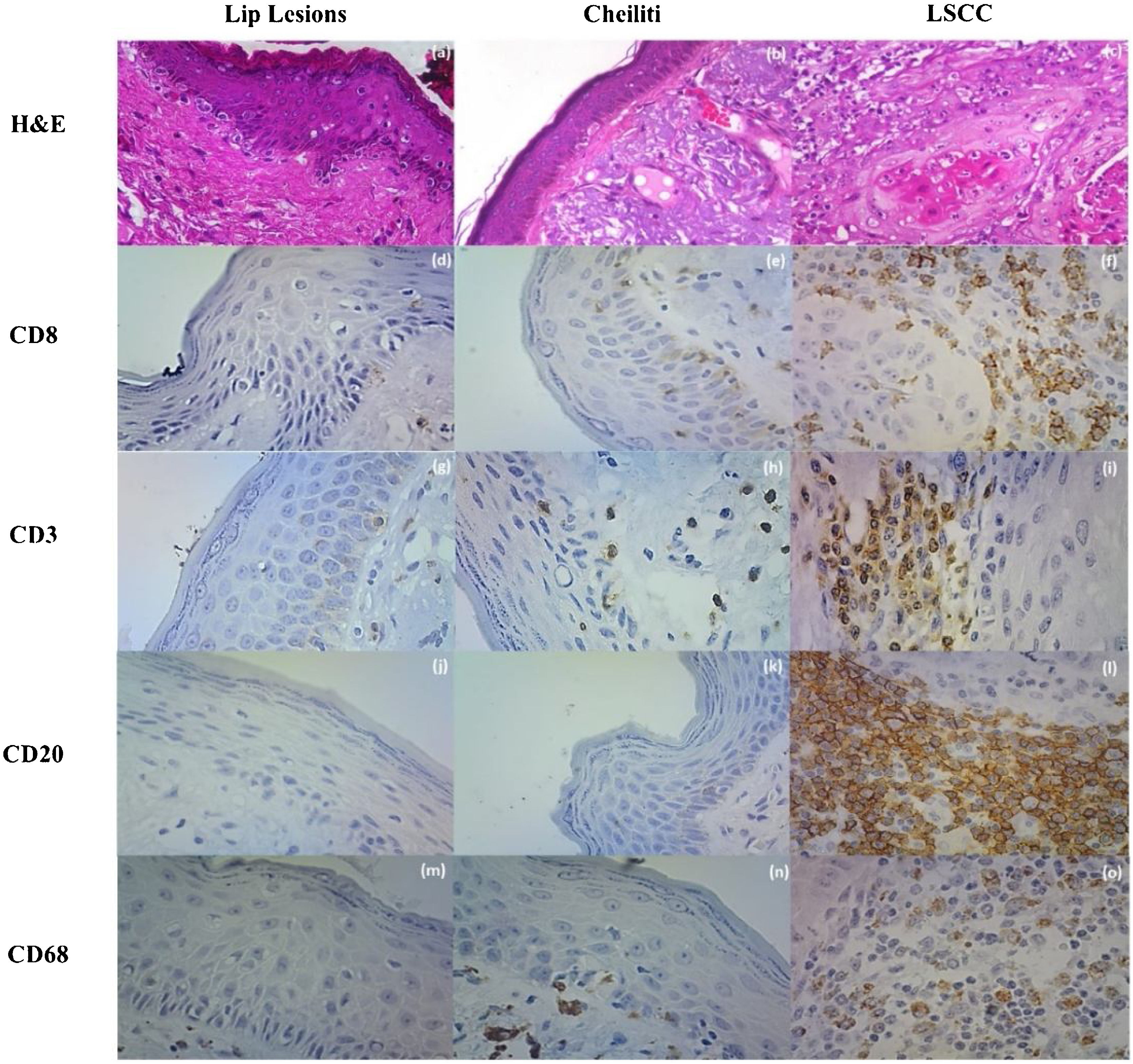 Deficiency in infiltration of CD8/CD3 positive lymphocytes and ...