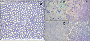 Histological images of the evolution of an axonotmesis-like lesion of the facial nerve. Axonotmesis: facial nerve injury by compression and evolution at 6 weeks. (A) Normal facial nerve. (B) Facial nerve 1 week after the injury showing significant degeneration, with loss of the myelin sheath. (C) Facial nerve 2 weeks after injury. (D) Facial nerve 4 weeks after injury. (E) Facial nerve 6 weeks after the injury with a structure already quite similar to the normal facial nerve.