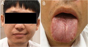 Characteristics of Melkersson–Rosenthal Syndrome. Facial paralysis in (A) and lingua plicata in (B).