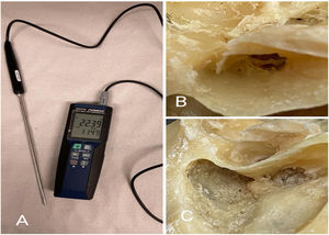 Thermometer used and preparation of the temporal bone. (A) Omega® HH376 thermometer with 5.0 mm diameter probe. (B) External Acoustic Canal (EAC) showing absence of tympanic membrane, with preserved ossicular chain. (C) Posterior tympanotomy region (red arrow).