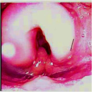 The first flexible nasoendoscopic view of the larynx demonstrating supraglottic oedema.