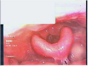 Repeat flexible nasoendoscopy 1 month after starting methotrexate. Note the improved laryngeal inlet appearance.