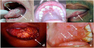 Representative images of OOPML of patients attended at the Otorhinolaryngology Service of the Evandro Chagas National Institute of Infectious Diseases (INI-FIOCRUZ), from 2005 to 2017: (a) Squamous cell carcinoma (arrows); (b) tuberculosis (arrow); (c) syphilis (arrow); (d) American tegumentary leishmaniasis (arrow); and (e) paracoccidioidomycosis (arrows).