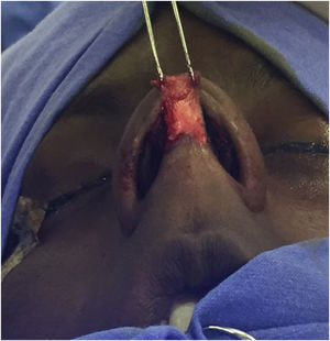 Septorhinoplasty the open approach (author’s archive).