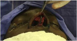 A tongue-in-groove stabilization with multiple PDS is performed between the medial crura and the caudal portion of the neoseptum (author’s archive).