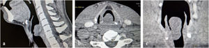 Computed tomography image of laryngeal schwannoma. (a) Sagittal view; (b) axial view; (c) coronal view.