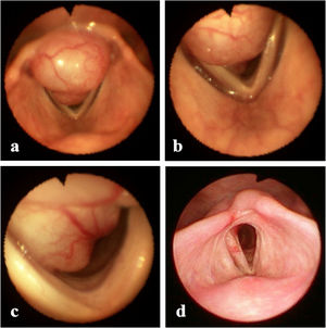 Endoscopic appearance of laryngeal schwannoma. (a) Supraglottic portion; (b) glottic portion; (c) subglottic portion; (d) 7-months after surgery: no visible laryngeal tumor.