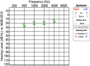 Audiometry of patient 3, at 3-years and 4-months-old.