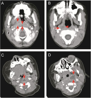 Enhanced neck computed tomography. (A) Retropharyngeal and right parapharyngeal cellulitis (arrowheads). (B) Right parapharyngeal cellulitis (arrowheads). (C) Retropharyngeal abscess with rim enhancement (arrowheads). (D) Left parapharyngeal abscess with rim enhancement (arrowheads).