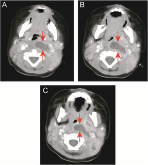 Case 1: a patient with KD and deep neck abscess who underwent incision and drainage surgery. (A, B, and C) Enhanced neck computed tomography showing a neck abscess.