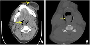 (A) Preoperative CT showed that the upper respiratory tract in the oropharynx and throat was occupied by soft tissue density and extended into the mouth. (B) Preoperative CT showed a huge, large mass in the laryngopharynx with visible dilatation of the esophageal entrance.