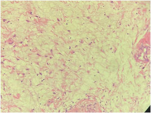 Postoperative pathological findings revealed hyperplasia of adipose tissue (hypopharynx), with a partial envelope, consistent with lipoma. The surface surrounding the tumor was partially covered with squamous epithelium, accompanied by inflammation, and inflammatory necrotic tissue.