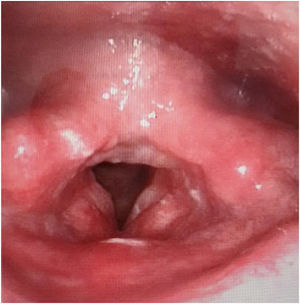 After 8-years of follow-up, laryngoscopy showed no recurrence of mass.