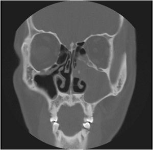 Radiology findings at the first visit, the paranasal sinus computed tomography coronal view revealed a nonhomogeneous soft tissue density in the left maxillary and ethmoid sinuses without bony remodeling.