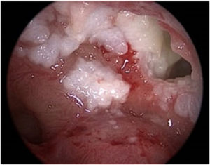 Nasal endoscopic findings 3-years after the endoscopic sinus surgery (1st surgery). Whitish keratinous material observed around the left maxillary sinus opening.