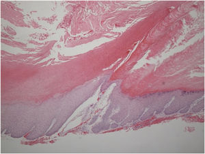 Histopathologic findings from Caldwell-Luc operation (2nd surgery). Microscopic examination revealed benign keratinized squamous lining with hyperkeratosis, parakeratosis (Hematoxylin and Eosin stain ×50).