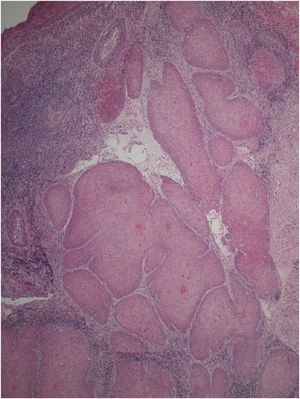 Histopathologic findings from the wide local excision (3rd surgery). Microscopic examination revealed irregularities in the basement membrane contour, along with the loss of cellular polarity, indicating well-differentiated squamous cell carcinoma (Hematoxylin and Eosin stain ×50).