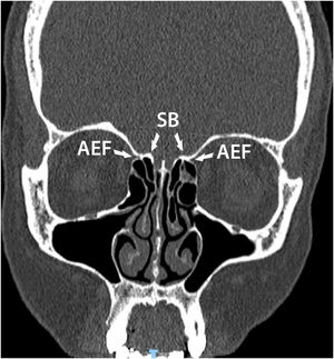 Computed tomography in coronal reconstruction showing anterior ethmoidal artery adhered to the skull base. SB, Skull Base; AEF, Anterior Ethmoidal Foramen.