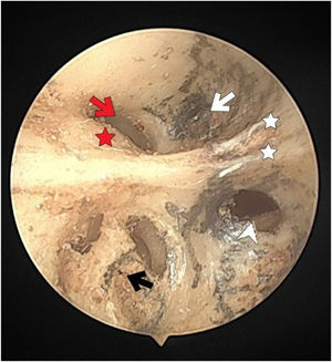 The fundus of internal acoustic meatus (view from medial side of the right temporal bone). Cochlear nerve foramen (black-arrow); the buldge of facial canal (red-star); canals for superior vestibular nerve (white-arrow); transverse crest (white-star); facial canal (red-arrow); inferior vestibular nerve foramen (white-arrowhead).