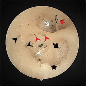 The fundus of internal acoustic meatus (left temporal bone). Facial canal (red-arrow); canals for singular nerve (black-arrowhead); saccular nerve foramina (white-arrowhead); canals for superior vestibular nerve (white-arrow); anterior crest (black-star); foramen of the transverse crest (red-arrowhead).