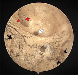 The fundus of internal acoustic meatus (right temporal bone). Crest of Facial canal (red-star); facial canal (red-arrow); Foramina for cochlear nerve (black-arrow); canals for singular nerve (black-arrowhead); canals for superior vestibular nerve (white-arrow).