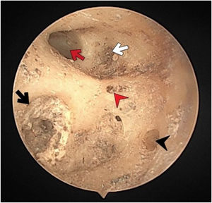 The fundus of internal acoustic meatus (right temporal bone). Facial canal (red-arrow); foramen of the transverse crest (red-arrowhead); canals for superior vestibular nerve (white-arrow); foramina for cochlear nerve (black-arrow); canals for singular nerve (black-arrowhead).