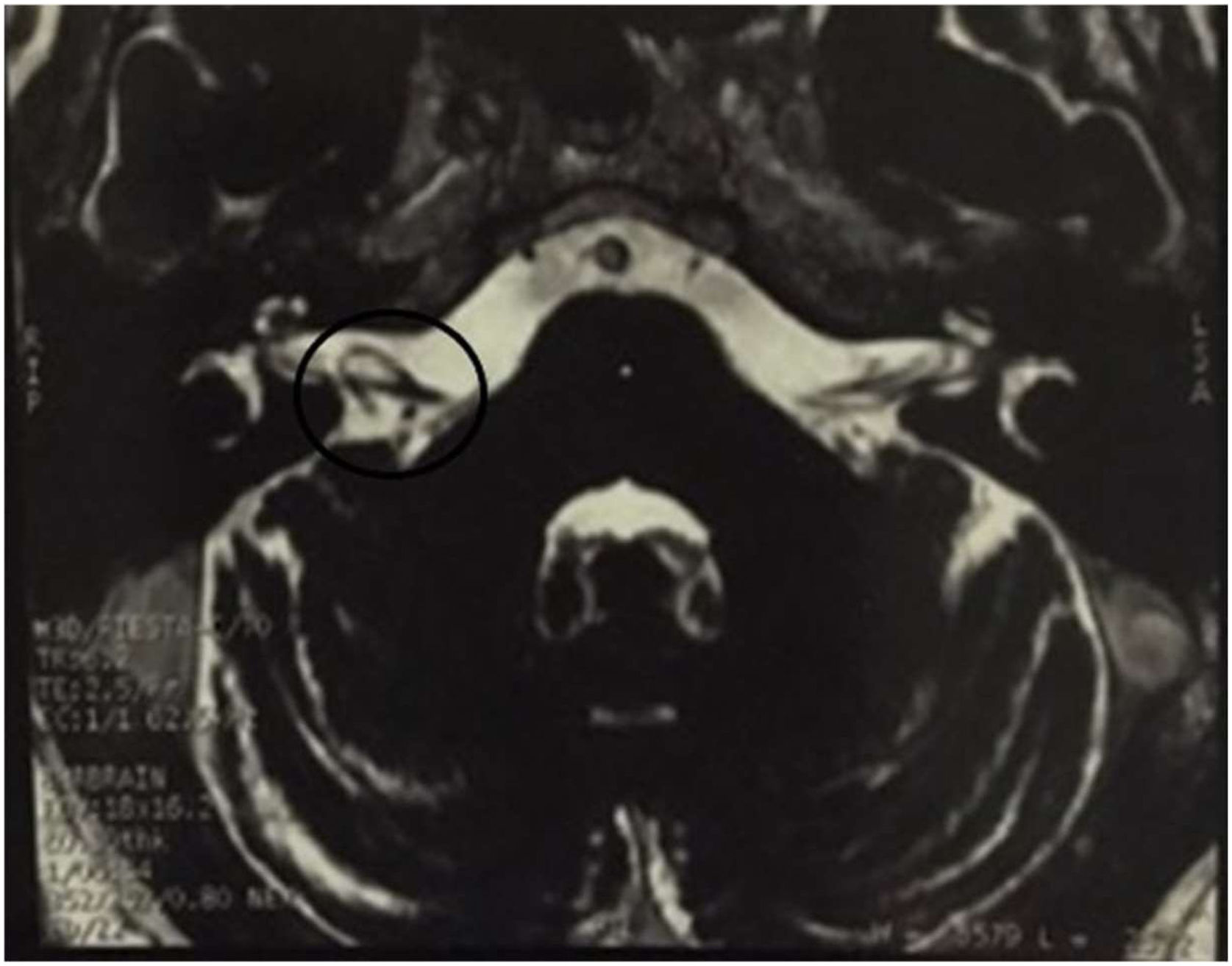 Vertij Pozitional Positional vertigo ‒ beyond benign paroxysmal positional vertigo: Case ...