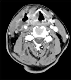 Axial CT scan showing direct spread of tumor through to hypopharyngeal wall and invasion of internal jugular vein.