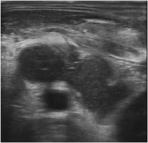Ultrasonography finding showing right internal jugular vein invasion.