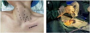 (A) Anatomical surface marking and incision design. (B) The trocars were punctured into the subcutaneous space.