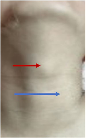 Mass between the thyroid cartilage and the cricoid cartilage (red arrow), body projection of anterior mass of the left carotid artery (blue arrow).
