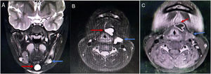 (A) Axial and (B) Coronal Magnetic Resonance Imaging (MRI) scan of the neck showed T2-weighted hyperintense signals seen between the hyoid (red arrow) and thyroid cartilage and in front of the left carotid artery (blue arrow). (C) Enhanced MR Imaging (DCE-MRI) scan of the neck showed the hyoid bone and the anterior thyroid cartilage lesions showed ring enhancement (red arrow) and the lesions in the left anterior carotid artery showed mild uneven enhancement (blue arrow).