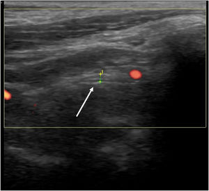 Ultrasound imaging/measurement (longitudinal view) of the facial nerve (white arrow) as they exit the stylomastoid foramen.