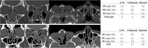 CT images showing different evaluation patterns. Axial and coronal bone window CT images. The upper case shows the presence of ethmoid-dominant shadow. The lower case shows the absence of ethmoid-dominant shadow. AE, Anterior Ethmoid Sinus; PE, Posterior Ethmoid Sinus; M, Maxillary Sinus; E/M, Ethmoid-to-Maxillary sinus ratio; L-M, Lund and Mackay scoring system; S, Simplified.